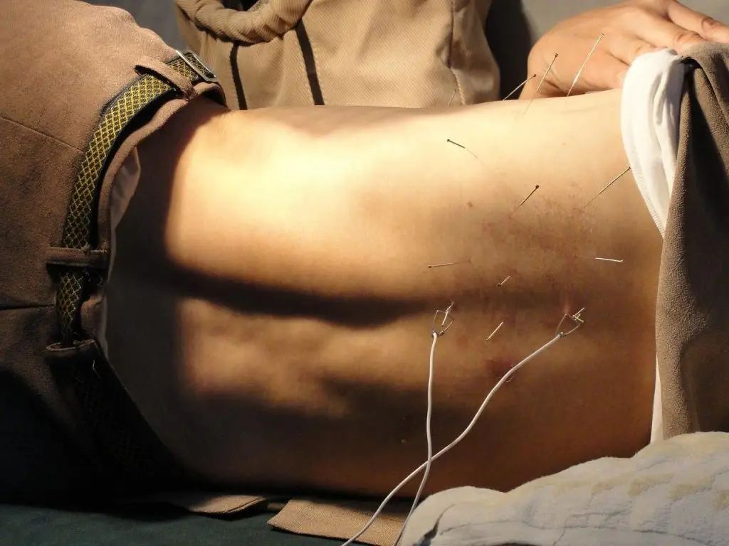 Acupunctuur in Enschede